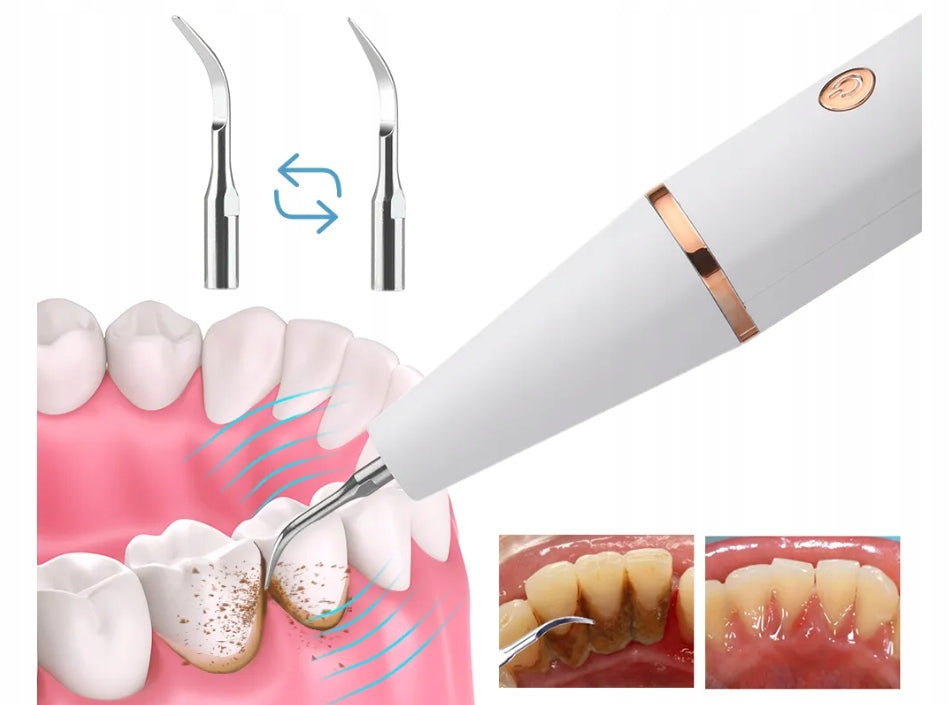 ULTRASONIC DENTAL SCALER FOR TEETH 3 MODE Brand Heelly